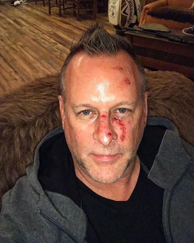 full-houses-dave-coulier-shares-throwback-photo-of-bloody-face-from-fall-reveals-he-is-alcoholic.jpg